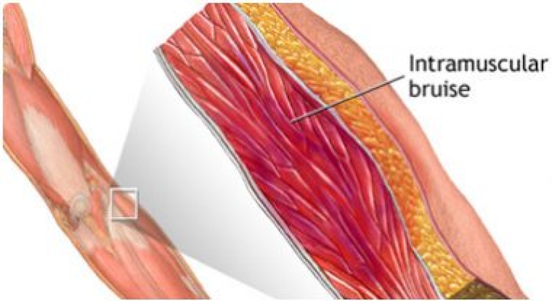 Intramuscular bruise: bầm trong cơ