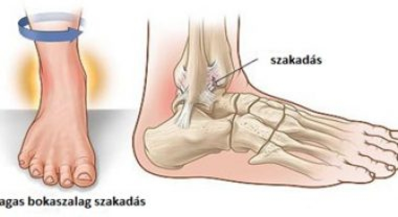 Periosteal bruise: bầm trong màng xương