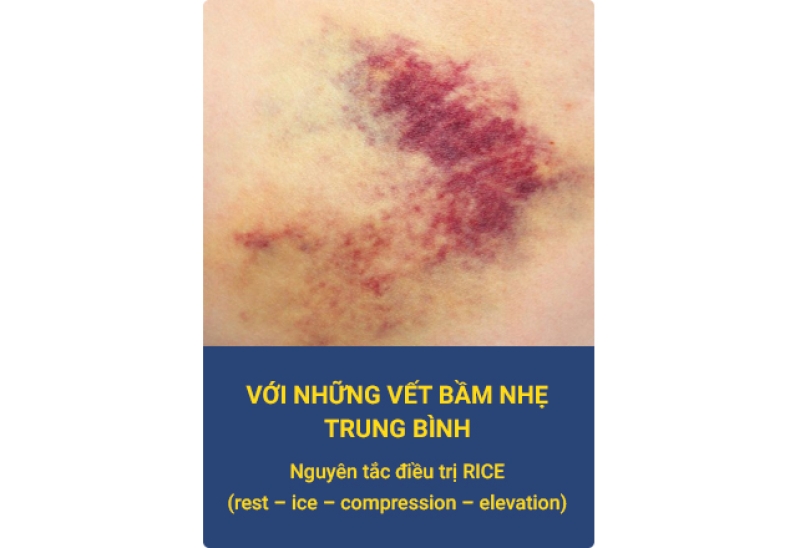 Kem tan máu bầm sau phẫu thuật Postopix cream