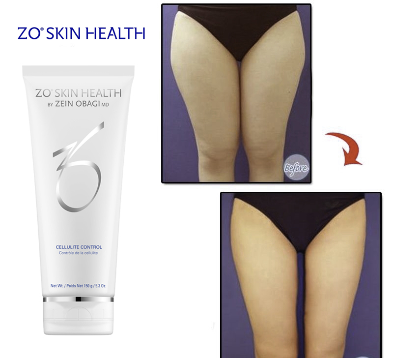 Kem tan mỡ cứng cục bộ Zo Skin Health Cellulite Control